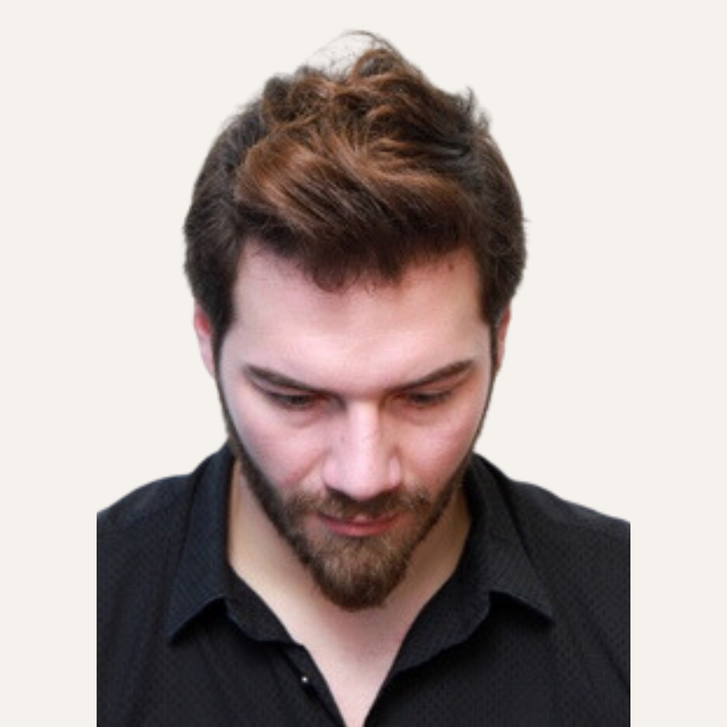 Hair Transplant